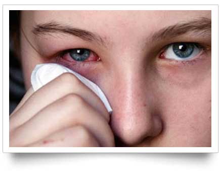 conjuntivitis alergica