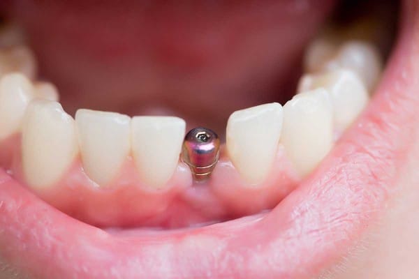 boca-con-implante-dental